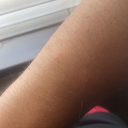 Bug bites from one night Bug bites from one night