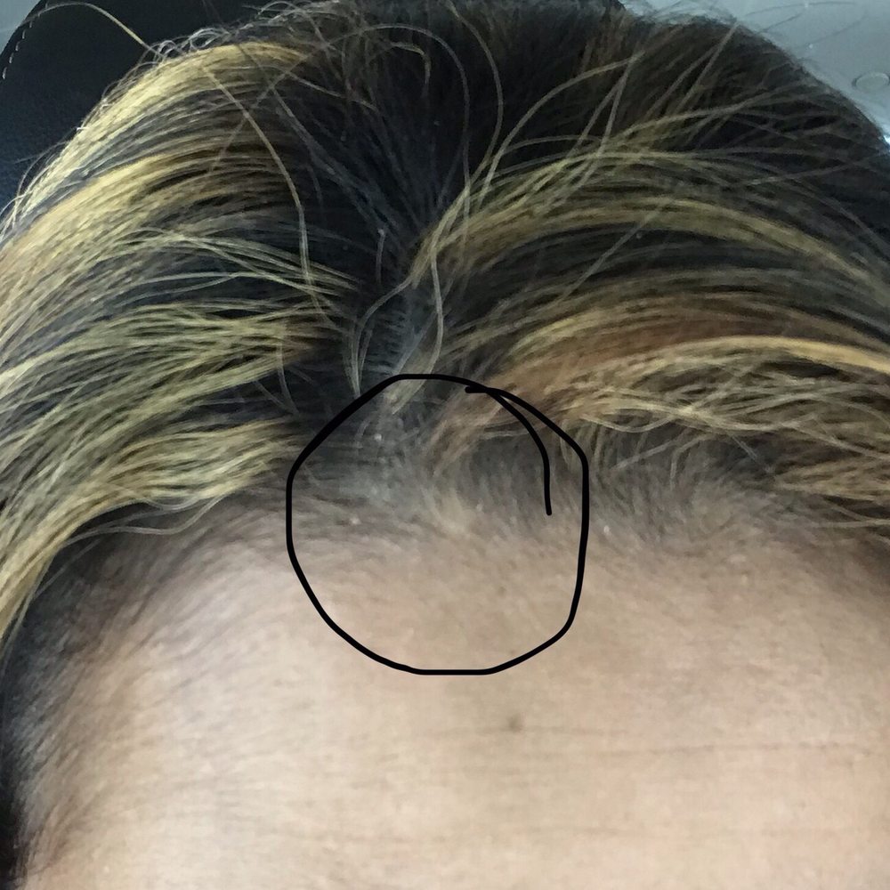 Bleach in scalp made me look like I have a bold spot. I'm embarrassed by it :/ Bleach in scalp made me look like I have a bold spot. I'm embarrassed by it :/