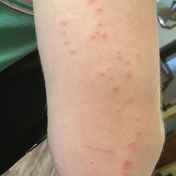 Sunset Motel - These are the bedbugs bites that ate up my son the 2 nights he stayed there!. His whole body looks this way ! - Hotels Near Me - Dallas, Georgia Sunset Motel - These are the bedbugs bites that ate up my son the 2 nights he stayed there!. His whole body looks this way ! - Hotels Near Me - Dallas, Georgia