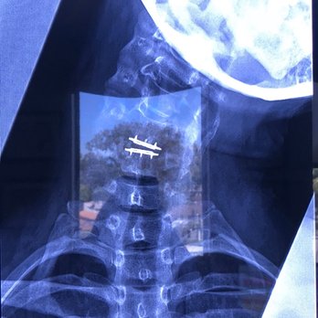 Lanman H Todd, MD - Lanman Spinal Neurosurgery - 4 years later - Spine Surgeons Near Me - Beverly Hills, California