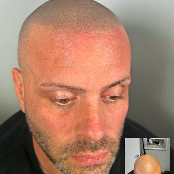 Smp Masters - Scalp Micropigmentation - Natural Hairline Restoration - Designed to create a soft, realistic hairline that complements the client's face. - Hair Loss Centers Near Me - Merrick,, New York Smp Masters - Scalp Micropigmentation - Natural Hairline Restoration - Designed to create a soft, realistic hairline that complements the client's face. - Hair Loss Centers Near Me - Merrick,, New York