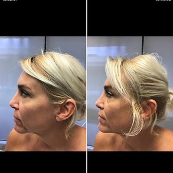 Introlift Med Spa - Before and 30 minutes later - Medical Spas Near Me - Plantation, Florida Introlift Med Spa - Before and 30 minutes later - Medical Spas Near Me - Plantation, Florida