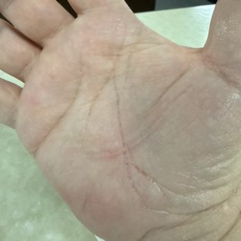 Pepper Pod Restaurant - My hand 10minutes after I helped the cook open the fish fry container. - Diners Near Me - Newport, Kentucky Pepper Pod Restaurant - My hand 10minutes after I helped the cook open the fish fry container. - Diners Near Me - Newport, Kentucky
