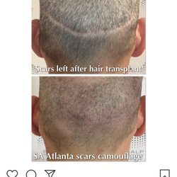 Diva-Derm Permanent Makeup / Silhouette House - Scar Camouflage Tattoo