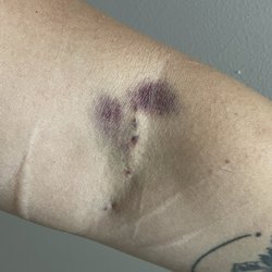 KEDPLASMA - Three days later it got a lot worse. They definitely pierced through more than one vein.