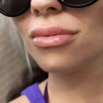 A Medical Spa At Rizzieri - After a few weeks after injection - Medical Spas Near Me - Moorestown, New Jersey A Medical Spa At Rizzieri - After a few weeks after injection - Medical Spas Near Me - Moorestown, New Jersey