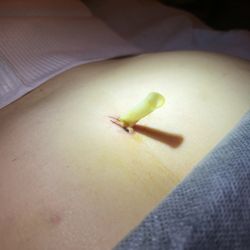 Downey Skin & Body Therapy - Client with a Penrose Drain we will remove for her.