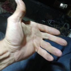 University Orthopaedic Associates - My hand Before my surgery ....