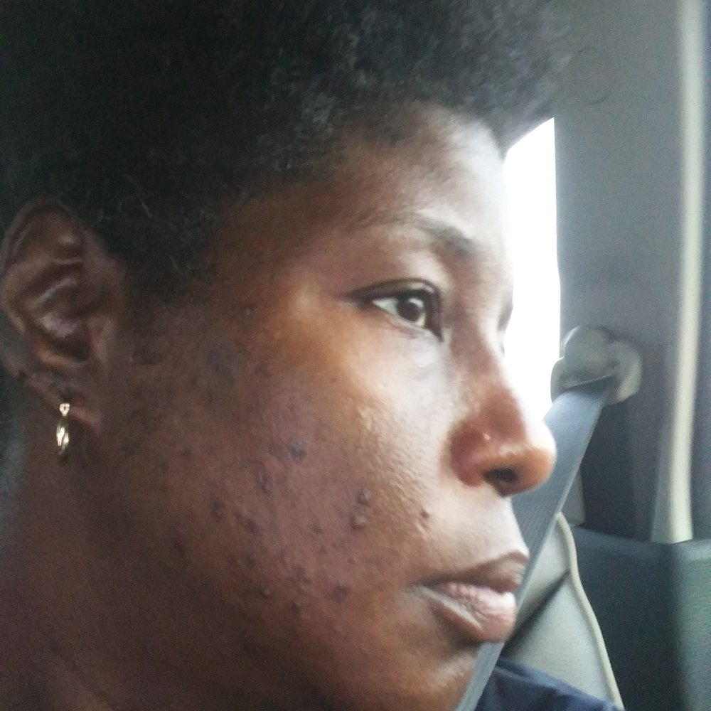 this is how bad acne broke out on my face, I was devastated when I went to see Dr. Schmidt