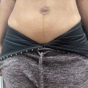 Zuri Plastic Surgery - Stomach : results from procedure - Plastic Surgeons Near Me - South Miami, Florida Zuri Plastic Surgery - Stomach : results from procedure - Plastic Surgeons Near Me - South Miami, Florida