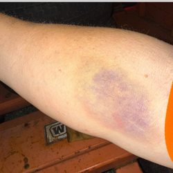 Quest Diagnostics - Where they took blood from the bottom vein
