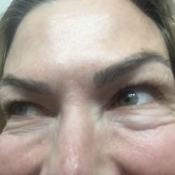 Extreme asymmetry. Lump under right eye.