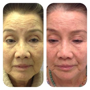 Kanebo Skincare - LHE Skin tighterning ,1 month later . - Skin Care Near Me - San Jose, California Kanebo Skincare - LHE Skin tighterning ,1 month later . - Skin Care Near Me - San Jose, California