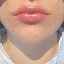 Flawless Skin Center - Immediately after.