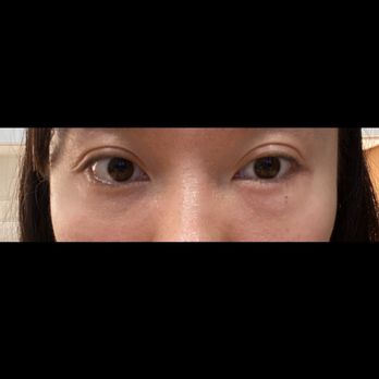 VIP Plastic Surgery - Fat graft was injected into left lower eyelid instead of the cheek. Upper eyelids awfully shaped & uneven. Both upper&lower eyelids botched. - Cosmetic Surgeons Near Me - Los Angeles, California