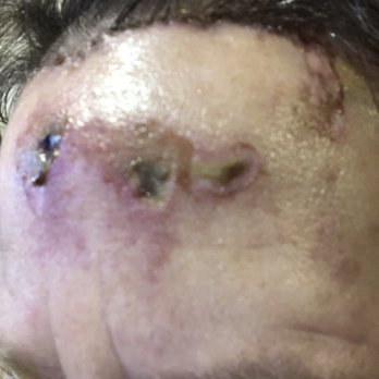 Novus Clinic - Blisters - Ophthalmologists Near Me - Tallmadge, Ohio Novus Clinic - Blisters - Ophthalmologists Near Me - Tallmadge, Ohio