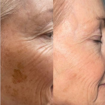 Timeless Aesthetics & Wellness - Laser Hair Removal Near Me - Cumming, Georgia Timeless Aesthetics & Wellness - Laser Hair Removal Near Me - Cumming, Georgia