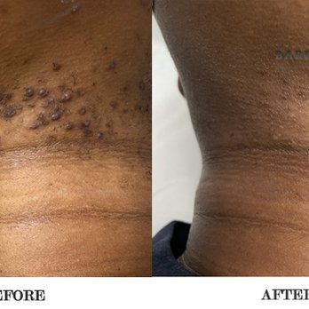 Bared Monkey Laser Spa - Get Rid of Painful Ingrown Hairs - Laser Hair Removal Near Me - New York, New York