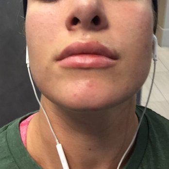 Neal Vallins DDS - 4 days later! Much bigger - General Dentistry Near Me - New York, New York Neal Vallins DDS - 4 days later! Much bigger - General Dentistry Near Me - New York, New York
