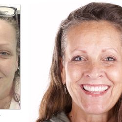 Primavera Dental Group - Dental implants