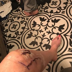 Oregon Outpatient Surgery Center - "...there will be about a one inch incision."