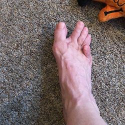 Metro Foot & Ankle - After recovery.