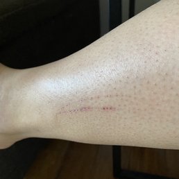 Scratches from pedicure.