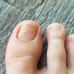 A toenail infection I found out a couple weeks after my service! A toenail infection I found out a couple weeks after my service!
