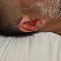 Valencie Exceus - Ear acupuncture in Fort Lauderdale