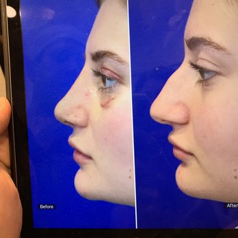John Diaz, MD - This is what my nose looked like after I took the cast off a week after surgery. It has gone down in size since then. - Cosmetic Surgeons Near Me - Beverly Hills, California