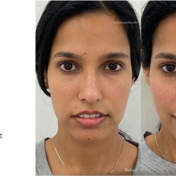 Sparrow MD - 4 Point Lift - Skin Care Near Me - Vancouver, British Columbia Sparrow MD - 4 Point Lift - Skin Care Near Me - Vancouver, British Columbia