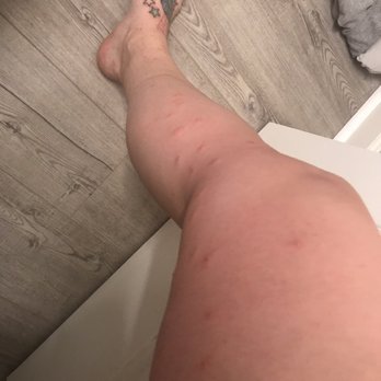 Massanutten Resort - Bed bug bites all the way down my leg - Hotels Near Me - Massanutten, Virginia Massanutten Resort - Bed bug bites all the way down my leg - Hotels Near Me - Massanutten, Virginia