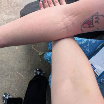 Talecris Plasma Resources - The "bruising" that was too bad to donate plasma - Blood & Plasma Donation Centers Near Me - Raleigh, North Carolina Talecris Plasma Resources - The "bruising" that was too bad to donate plasma - Blood & Plasma Donation Centers Near Me - Raleigh, North Carolina