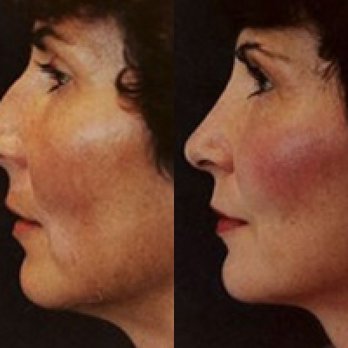Harry Mittelman, MD - Rhinoplasty Before and After - Cosmetic Surgeons Near Me - Los Altos, California Harry Mittelman, MD - Rhinoplasty Before and After - Cosmetic Surgeons Near Me - Los Altos, California