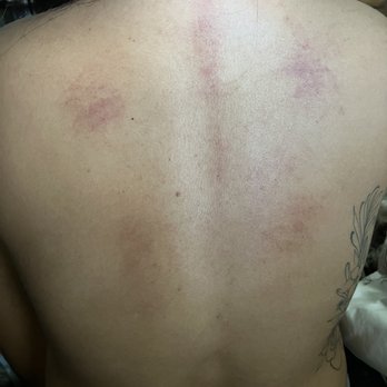 Loess Spa - Bruised up from their massage tool - Reflexology Near Me - Honolulu, Hawaii
