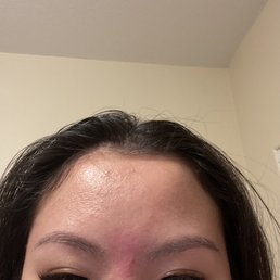 Burn on forehead and barely-there extensions Burn on forehead and barely-there extensions