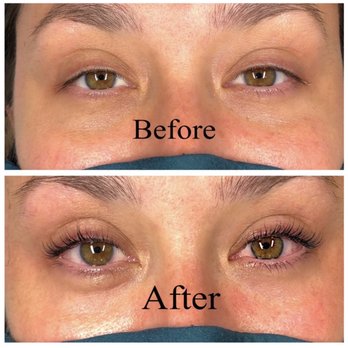AJ Beauty Skin Care - Before & after - Skin Care Near Me - Saddle Brook, New Jersey