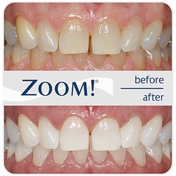 Dentistry for Woodstock - We offer Zoom! Teeth Whitening, which is a professional whitening service that can bring your teeth up to 6 shades lighter in just two hours