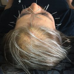 Acupuncture Westside
