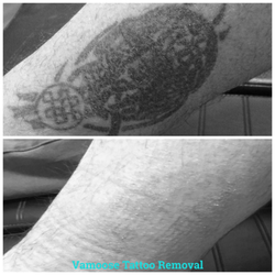 Removery Tattoo Removal & Fading