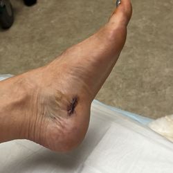 Montecito Healthcare Center Pediatrics - Plantar fasciitis surgery- Dr Hambrecht