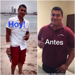 Dr. Sergio Verboonen - After and before picture
