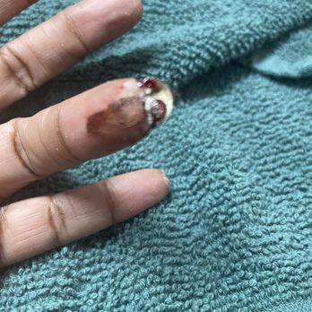 Diamond Nails and Spa - My finger after the tech trued to stop the bleeding. - Nail Salons Near Me - Saint Charles, Maryland Diamond Nails and Spa - My finger after the tech trued to stop the bleeding. - Nail Salons Near Me - Saint Charles, Maryland