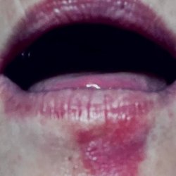 Community Care Rheumatology - This is my cold sore that I often get because I have an immune disorder. But Dr Jessica Chapman doesn't think I do!