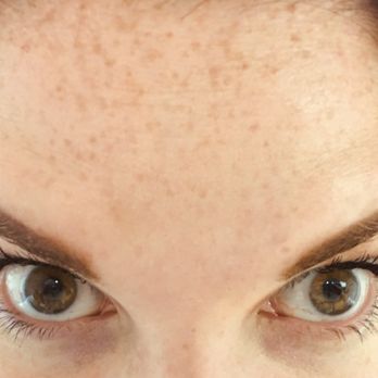Ari Hyman, MD - 1 week after botox - Cosmetic Surgeons Near Me - Encino, California Ari Hyman, MD - 1 week after botox - Cosmetic Surgeons Near Me - Encino, California