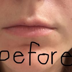 Skin Love - Before lips