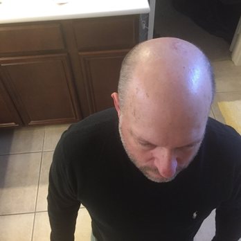 Zang SMP - Before - Hair Loss Centers Near Me - Los Angeles, California