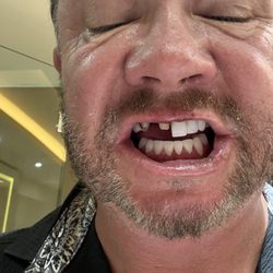 Cancún Cosmetic Dentistry - Missing crowns and lip infection.
