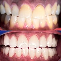 Annie Nguyen, DDS - Brand new smile in 2 weeks by Dr. Annie