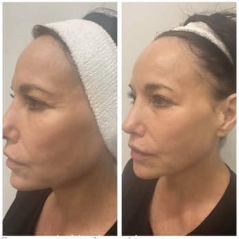 LA Skincare Center - Xerf Before and after only 1 treatment - Skin Care Near Me - El Segundo, California LA Skincare Center - Xerf Before and after only 1 treatment - Skin Care Near Me - El Segundo, California
